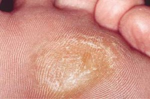 5 natuurlijke remedies voor het verzachten van eelt