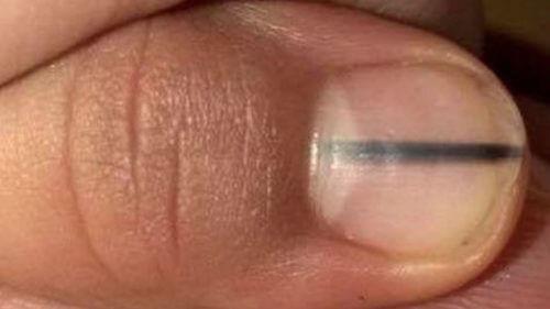 Hoe een zwarte lijn op je nagel een teken van kanker kan zijn
