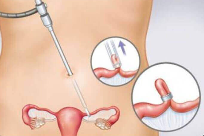 Eeen spiraaltje is een van de premanente anticonceptiemiddelen