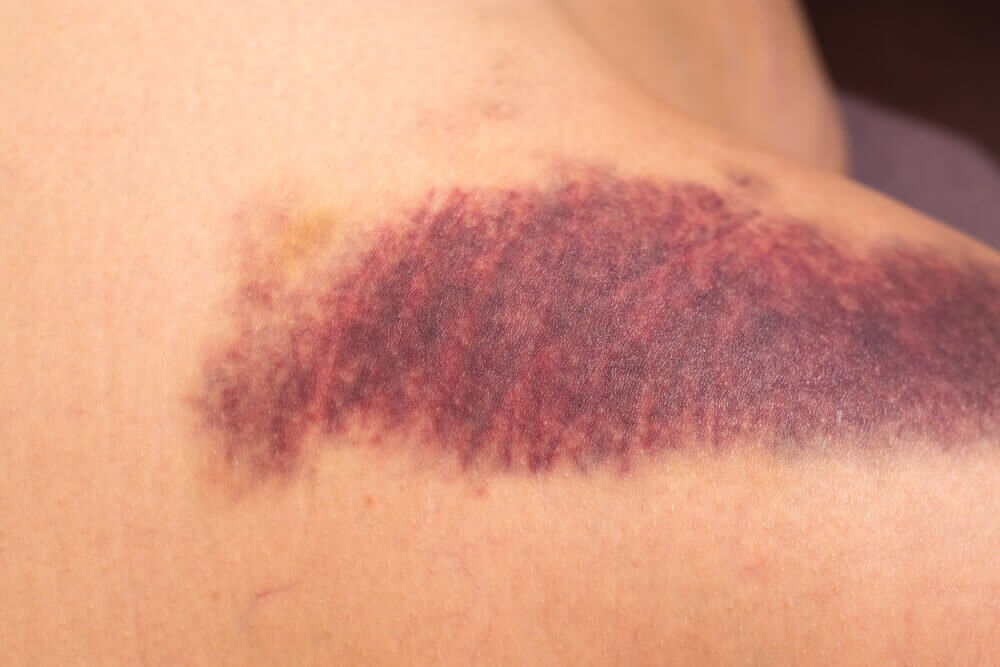 Blauwe plek als gevolg van een vitamine K-tekort