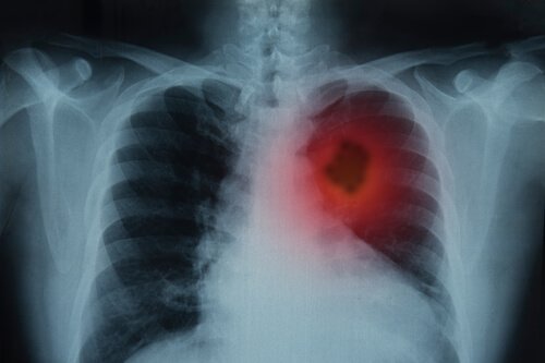 Röntgenfoto longkanker