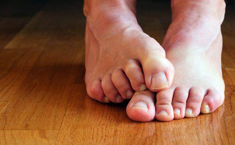 Wat zijn de oorzaken van nagelschimmel?