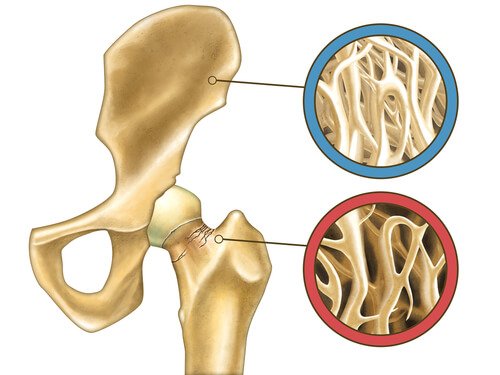 Botten die ons iets vertellen over osteoporose