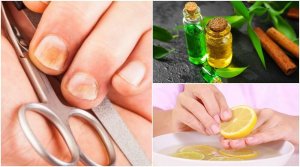 Vijf tips tegen kalknagels en voor sterke nagels