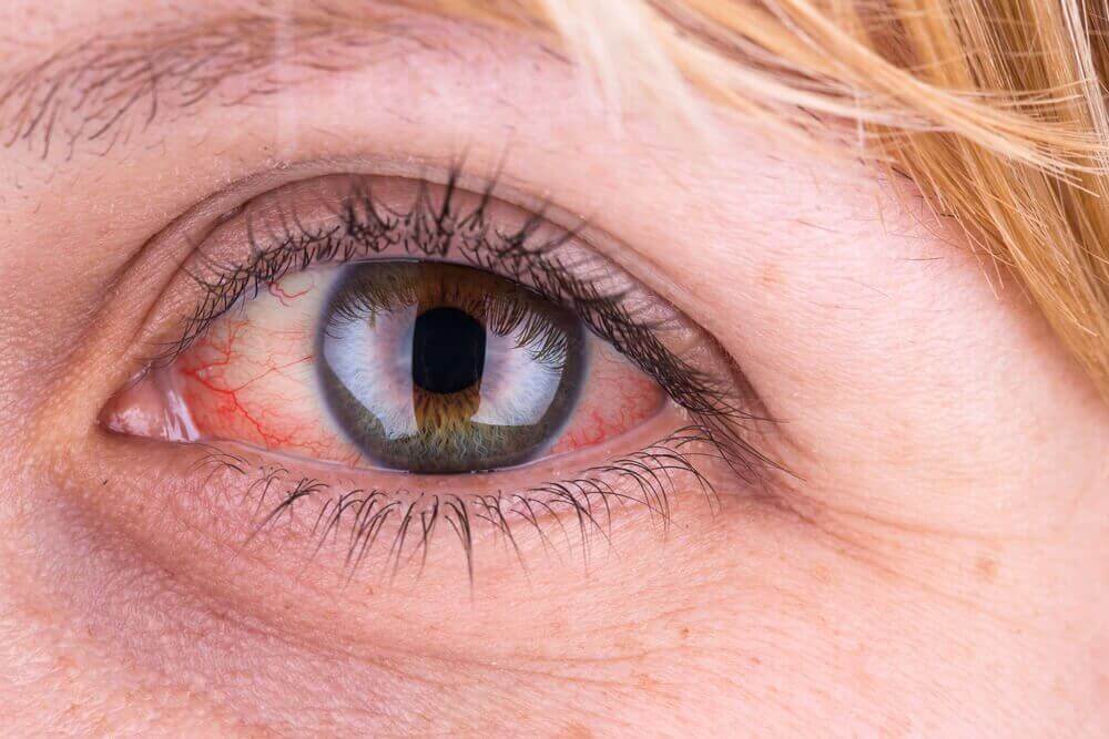 Rode ogen zijn kenmerkend voor een bindvliesontsteking