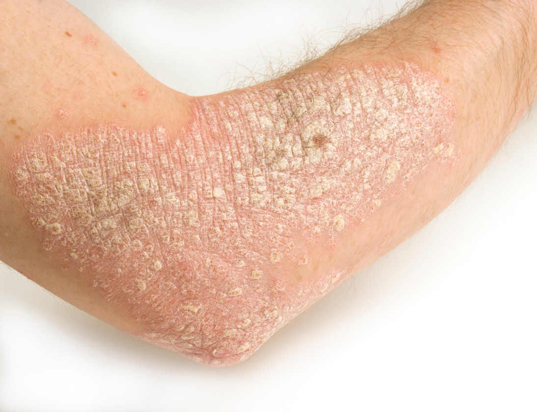 Aanbevelingen voor behandeling psoriasis met Sarsaparilla