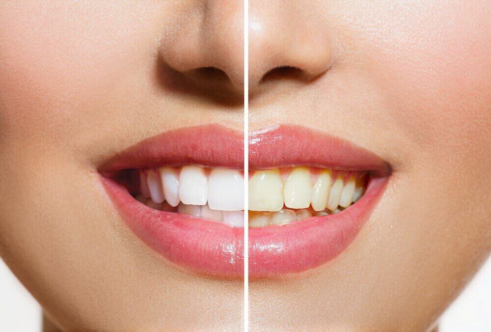 Je tanden witter maken met deze natuurlijke producten