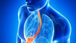 Reflux behandelen met de meest effectieve natuurlijke middelen
