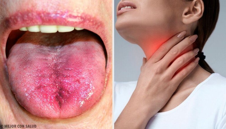 6 manieren om te weten of er witte plak in je keel zit