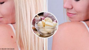 9 manieren om snel wratten te verwijderen