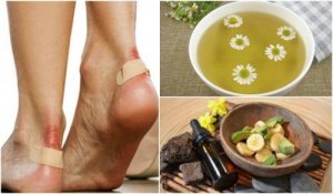 5 natuurlijke oplossingen om blaren te verlichten