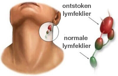 Controleer de lymfeklieren in je nek