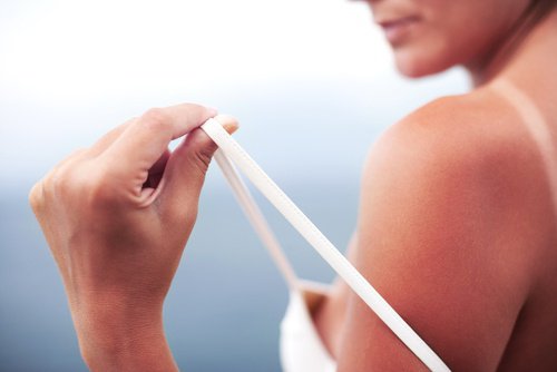 Behandel verbranding door de zon met 5 natuurlijke remedies