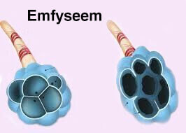 Emfyseem