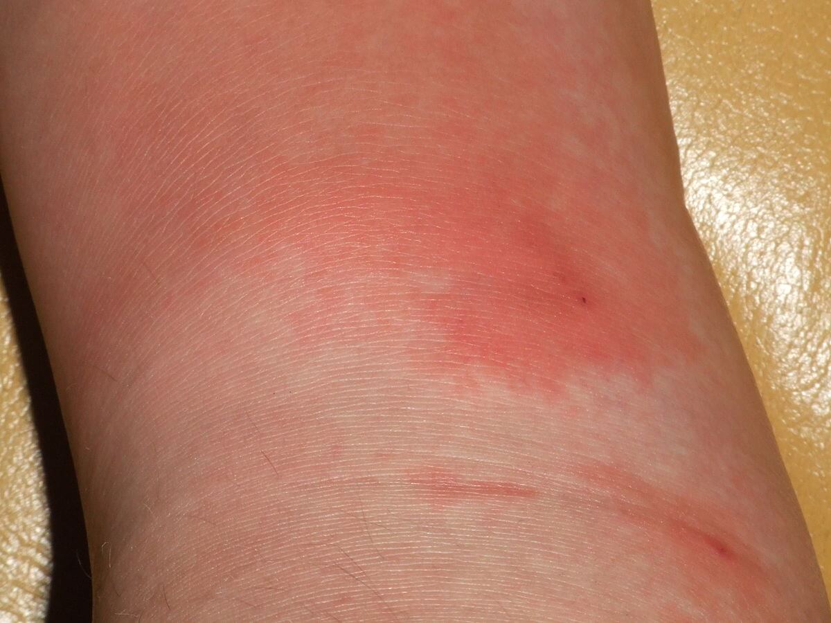 Huid met wondroos