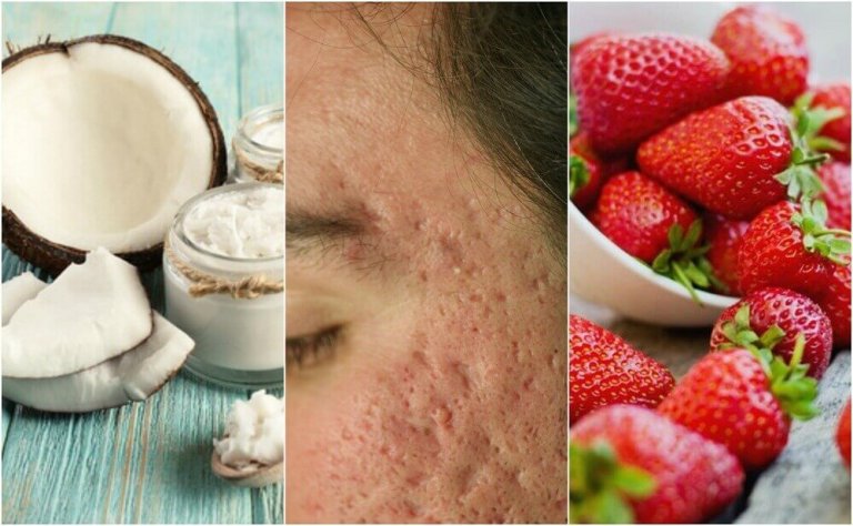 5 zelfgemaakte behandelingen om acne-littekens te verminderen