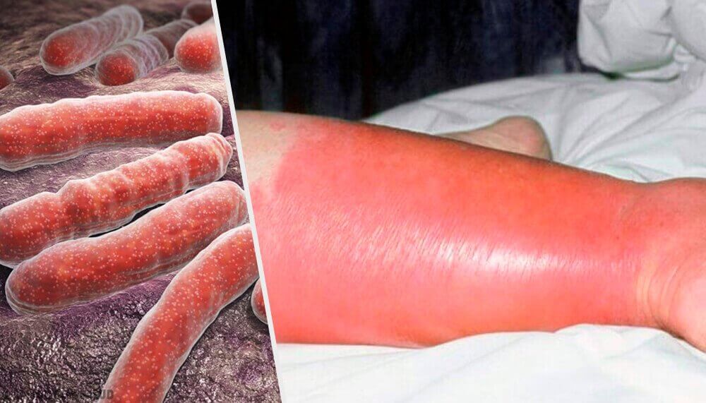 De huidinfectie wondroos: problemen en oplossingen