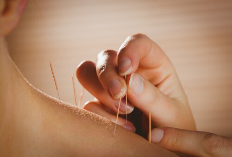 Acupunctuur voor de verlichting van rugpijn