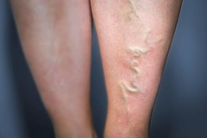 Aderontsteking behandelen met 5 natuurlijke middelen