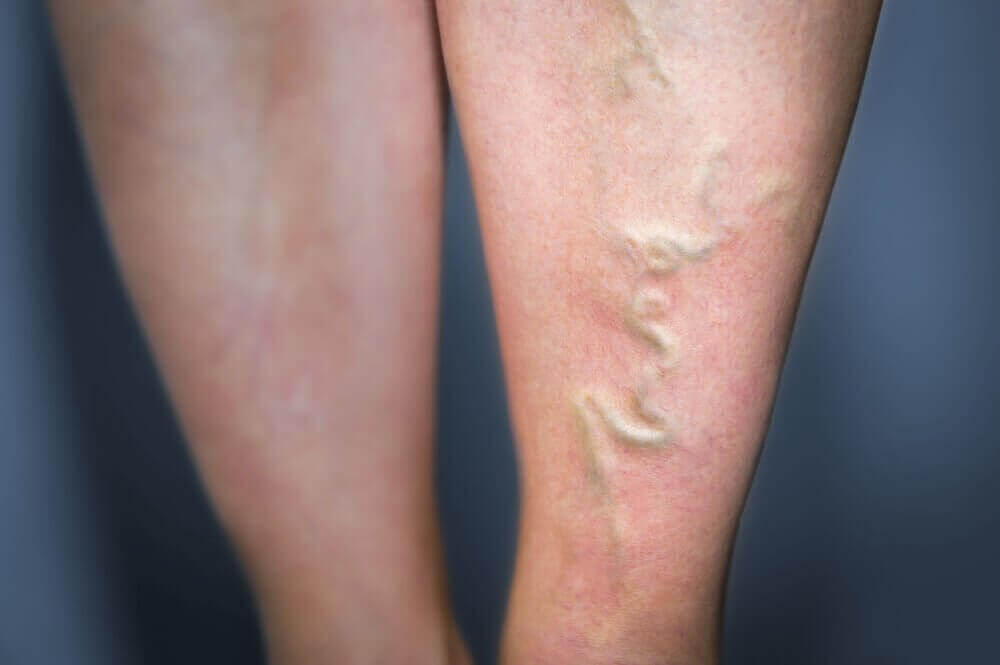 Aderontsteking behandelen met 5 natuurlijke middelen