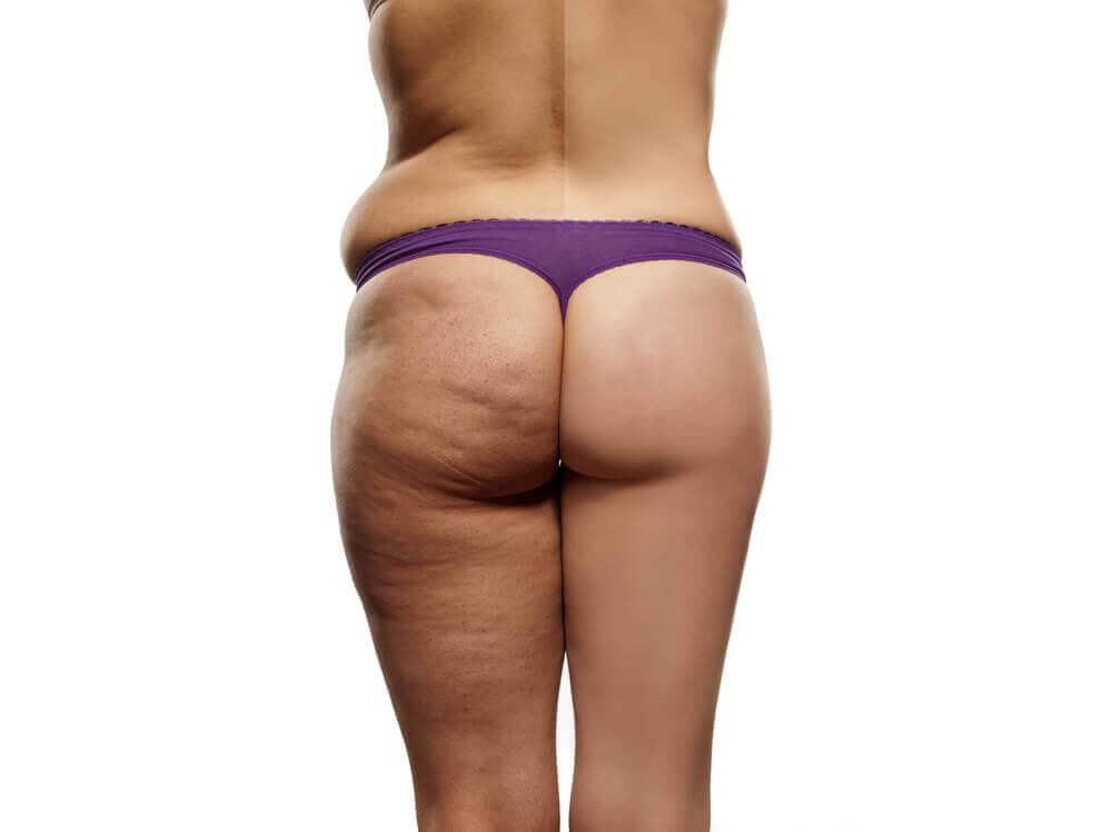Het perfecte anti-cellulitis dieetplan voor jou