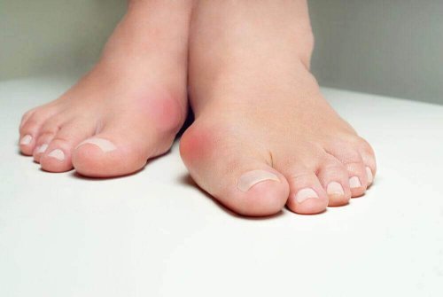 5 kruidenmiddeltjes die helpen tegen bunions