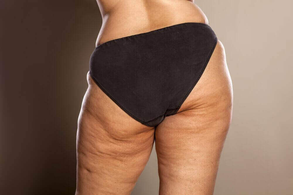 Fases in de ontwikkeling van cellulitis