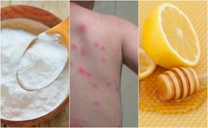 Verlicht vlooienbeten met 5 huisremedies