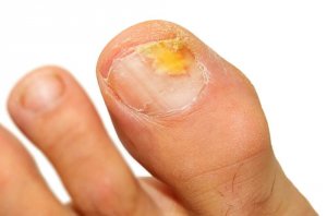 Schimmelnagels behandelen met etherische oliën