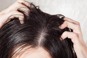 De 6 beste remedies om hoofdschimmel te bestrijden