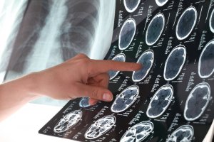 6 tips om een beroerte te voorkomen en het risico te verminderen