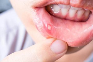 7 zelfgemaakte remedies om aften te genezen