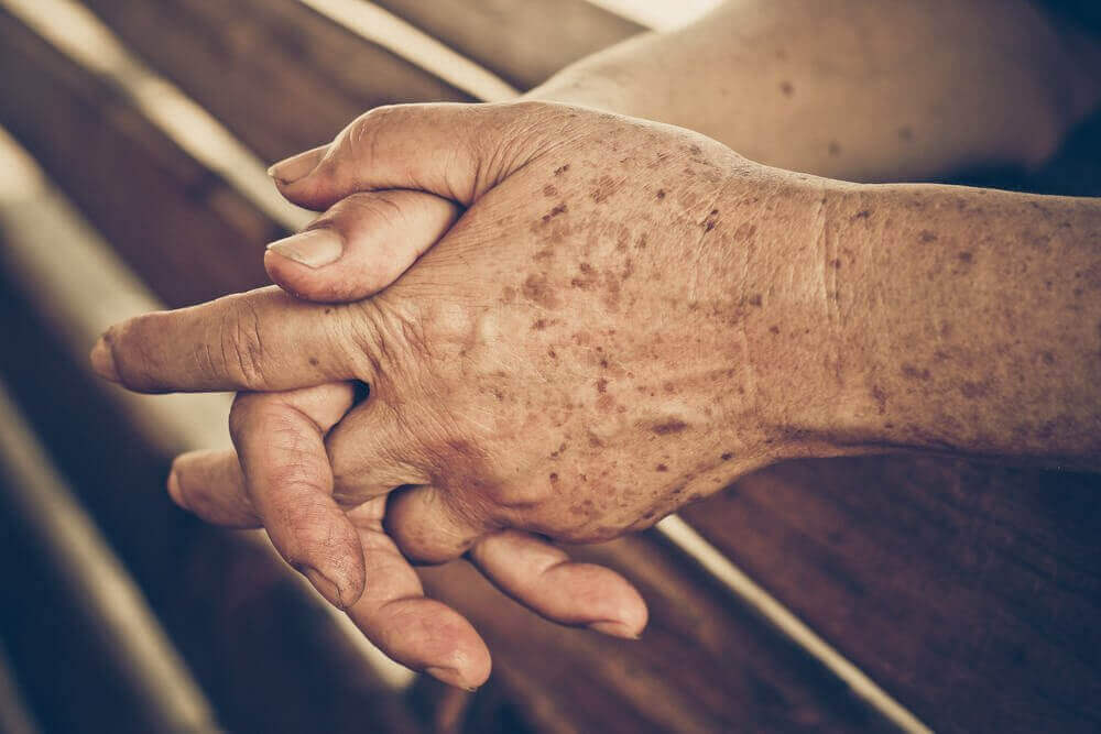 Ouderdomsvlekken behandelen: de 5 beste remedies