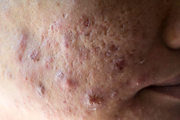 Basilicum tegen acne