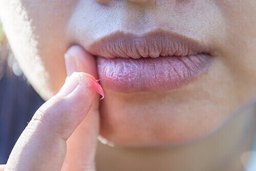 Gebarsten lippen