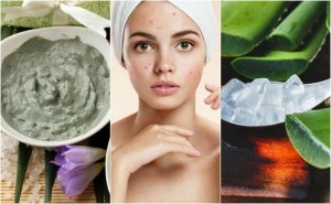 5 natuurlijke behandelingen voor acne in het gezicht