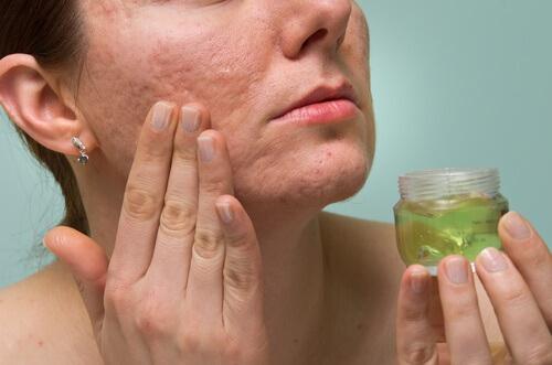 Oorzaken van acne-littekens