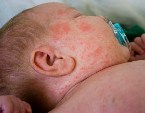 Warmte-uitslag bij baby's is niet ernstig