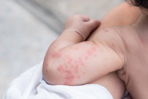 Is warmte-uitslag bij baby's een probleem?