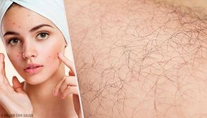 De oorzaken van hirsutisme en natuurlijke remedies om het te behandelen