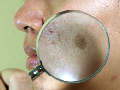 Een vergrootglas op een melasma vlek
