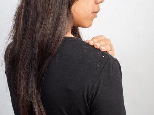 10 effectieve remedies tegen roos