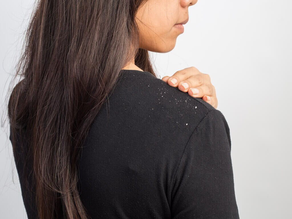 Roos is een veelvoorkomend hoofdhuidprobleem