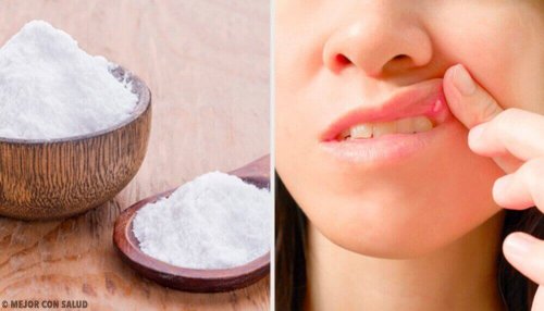 Natuurlijke remedies tegen mondzweren