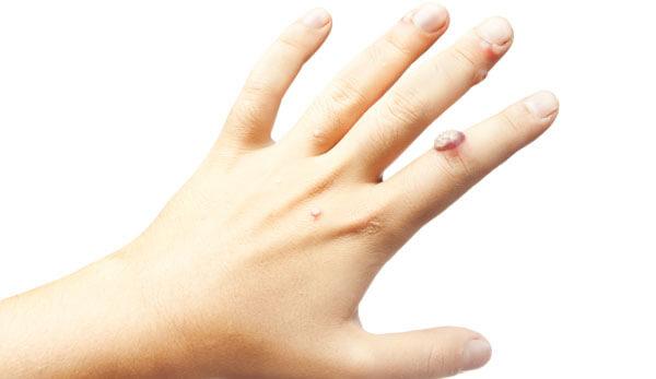Hand met wratten