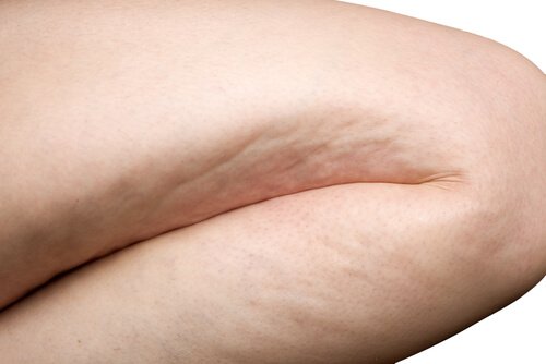 Cellulitis verergeren