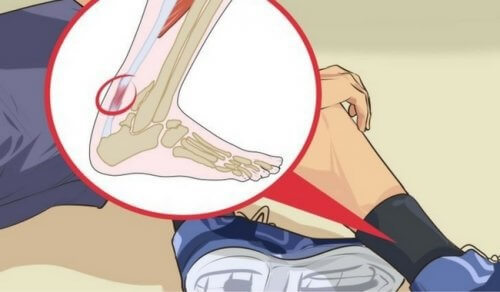 24 veelvoorkomende blessures bij dansers