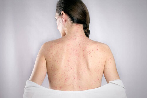 Herpes op de rug behandelen met 5 natuurlijke remedies