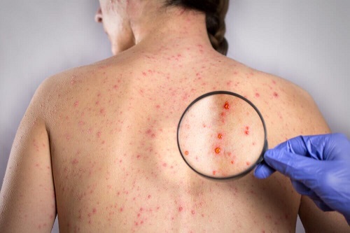 Herpes op de rug
