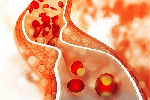 Symptomen van een hoog cholesterol
